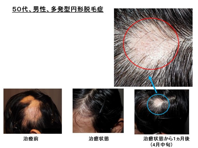円形脱毛症　病院